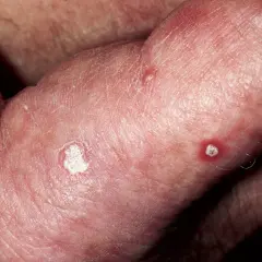 Piel enrojecida con escamas blancas y pequeñas lesiones, indicativas de queratosis actínica.