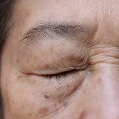 Piel con arrugas y manchas marrones, indicativo de lentigo solar benigno.