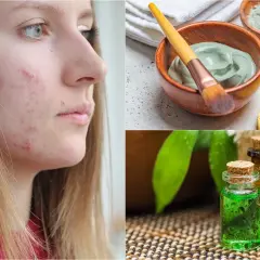 Rostro con acné y tratamientos naturales: mascarilla de arcilla, aceites esenciales y esponja. Adiós a cada grano ciego.