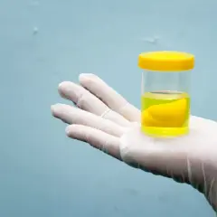 Muestra de orina oscura color coñac. Las causas pueden ser deshidratación, medicamentos o problemas hepáticos.