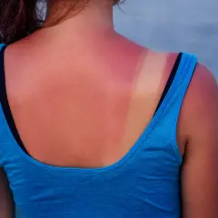 Espalda enrojecida por el sol, con una marca de bronceado. La pregunta de cuanto tiempo tomar el sol para ponerse moreno es clave para evitar esto.