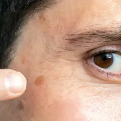 Un dedo señala unos lunares en la cara, cerca del ojo.