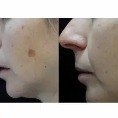 Comparación de rostro con manchas solares antes y después de aplicar remedios caseros para manchas en la cara por el sol.