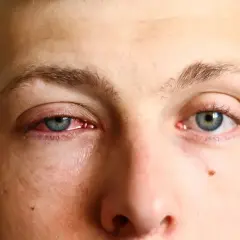 Ojo rojo e irritado, buscando remedios caseros para la conjuntivitis.