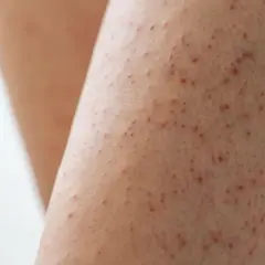 Piel de gallina con pequeños puntos rojos, como si el frío hubiera dejado su huella.