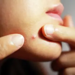 Dedos apuntan a un grano inflamado y doloroso en la barbilla.