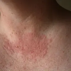 Piel enrojecida y con bultos en el cuello y pecho, posible reacción a la zonne allergie.