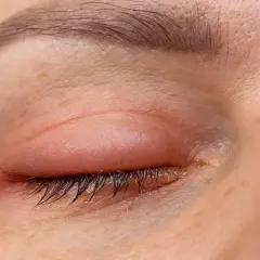 Ojo con párpado superior enrojecido e inflamado, formando un bulto que parece un pómulo hinchado sin dolor.