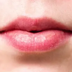 Labios agrietados y secos, con aspecto de labios quemados por el sol, mostrando la necesidad de protección e hidratación.
