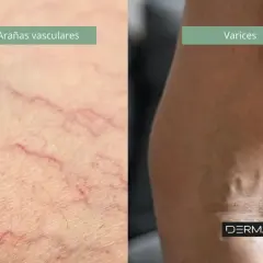 Comparación de arañas vasculares finas y varices más pronunciadas en la piel.