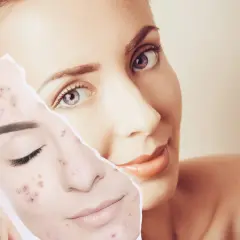Una mujer muestra una foto de su rostro con acné, preguntándose cuánto tarda en regenerarse la piel.