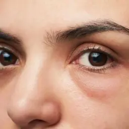 Ojos con ojeras marcadas y una leve hinchazón, sugiriendo una cara hinchada tras una noche de poco descanso.