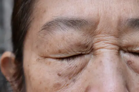 Piel con arrugas y manchas marrones, indicativo de lentigo solar benigno.