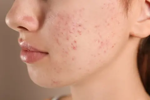 Primer plano de una mejilla con granitos en la cara, mostrando la textura de la piel y las imperfecciones.