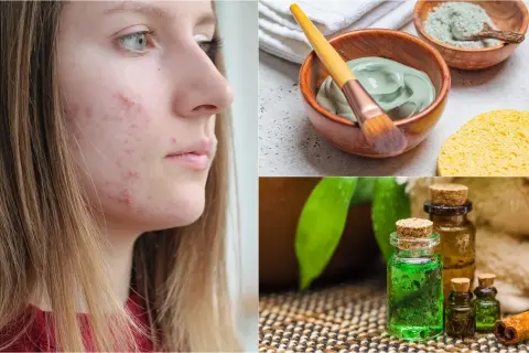 Rostro con acné y tratamientos naturales: mascarilla de arcilla, aceites esenciales y esponja. Adiós a cada grano ciego.