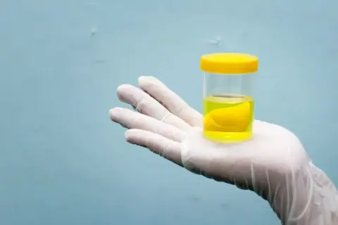 Muestra de orina oscura color coñac. Las causas pueden ser deshidratación, medicamentos o problemas hepáticos.