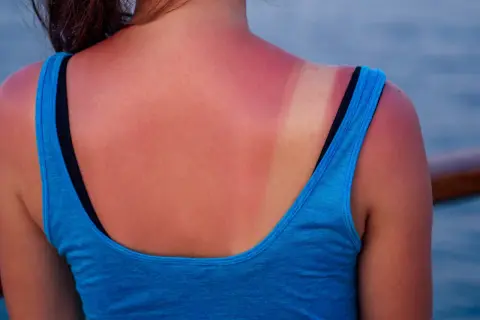 Espalda enrojecida por el sol, con una marca de bronceado. La pregunta de cuanto tiempo tomar el sol para ponerse moreno es clave para evitar esto.