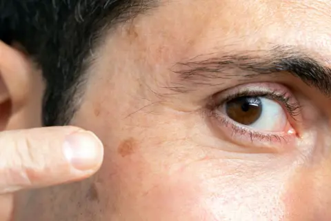 Un dedo señala unos lunares en la cara, cerca del ojo.
