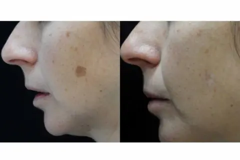 Comparación de rostro con manchas solares antes y después de aplicar remedios caseros para manchas en la cara por el sol.
