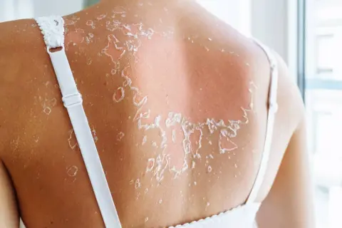 Piel escamándose tras una quemadura solar. La piel se desprende en parches blancos sobre un fondo enrojecido, mostrando el daño solar.