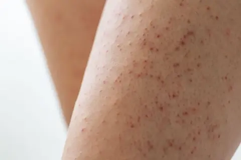 Piel de gallina con pequeños puntos rojos, como si el frío hubiera dejado su huella.