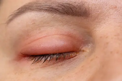 Ojo con párpado superior enrojecido e inflamado, formando un bulto que parece un pómulo hinchado sin dolor.