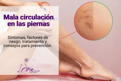 Piernas con mala circulación, mostrando arañas vasculares. Texto: "Mala circulación en las piernas. Síntomas, factores de riesgo, tratamiento y consejos para prevención.