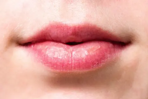 Labios agrietados y secos, con aspecto de labios quemados por el sol, mostrando la necesidad de protección e hidratación.