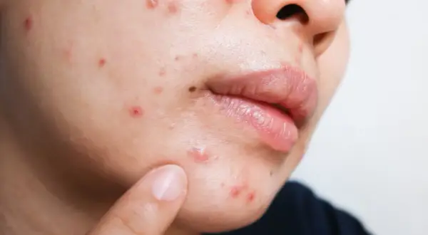 Piel con brotes y rojeces, posible queratosis pilaris. ¿Será el gluten el culpable?