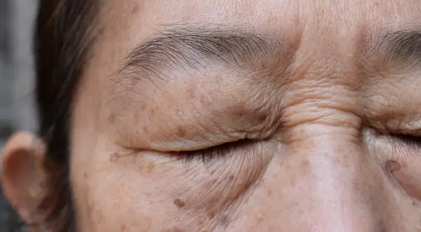 Piel con arrugas y manchas marrones, indicativo de lentigo solar benigno.