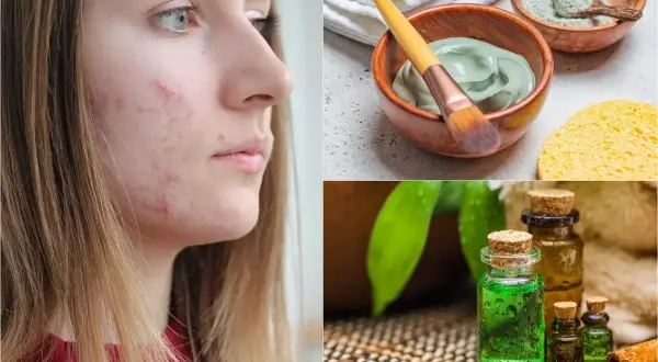 Rostro con acné y tratamientos naturales: mascarilla de arcilla, aceites esenciales y esponja. Adiós a cada grano ciego.