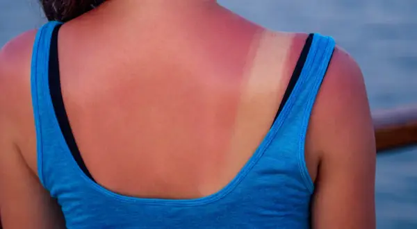 Espalda enrojecida por el sol, con una marca de bronceado. La pregunta de cuanto tiempo tomar el sol para ponerse moreno es clave para evitar esto.