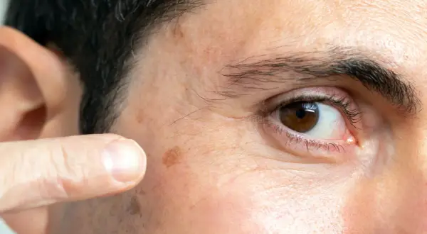 Un dedo señala unos lunares en la cara, cerca del ojo.