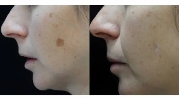 Comparación de rostro con manchas solares antes y después de aplicar remedios caseros para manchas en la cara por el sol.