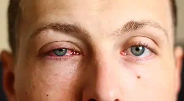 Ojo rojo e irritado, buscando remedios caseros para la conjuntivitis.