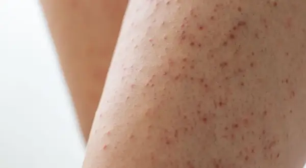 Piel de gallina con pequeños puntos rojos, como si el frío hubiera dejado su huella.