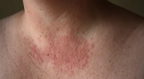 Piel enrojecida y con bultos en el cuello y pecho, posible reacción a la zonne allergie.