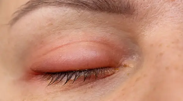Ojo con párpado superior enrojecido e inflamado, formando un bulto que parece un pómulo hinchado sin dolor.