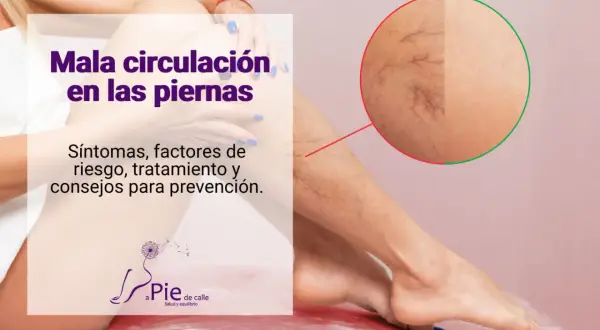 Piernas con mala circulación, mostrando arañas vasculares. Texto: "Mala circulación en las piernas. Síntomas, factores de riesgo, tratamiento y consejos para prevención.