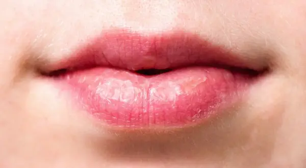 Labios agrietados y secos, con aspecto de labios quemados por el sol, mostrando la necesidad de protección e hidratación.