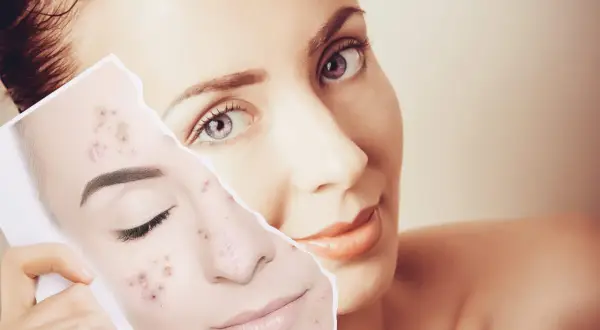 Una mujer muestra una foto de su rostro con acné, preguntándose cuánto tarda en regenerarse la piel.