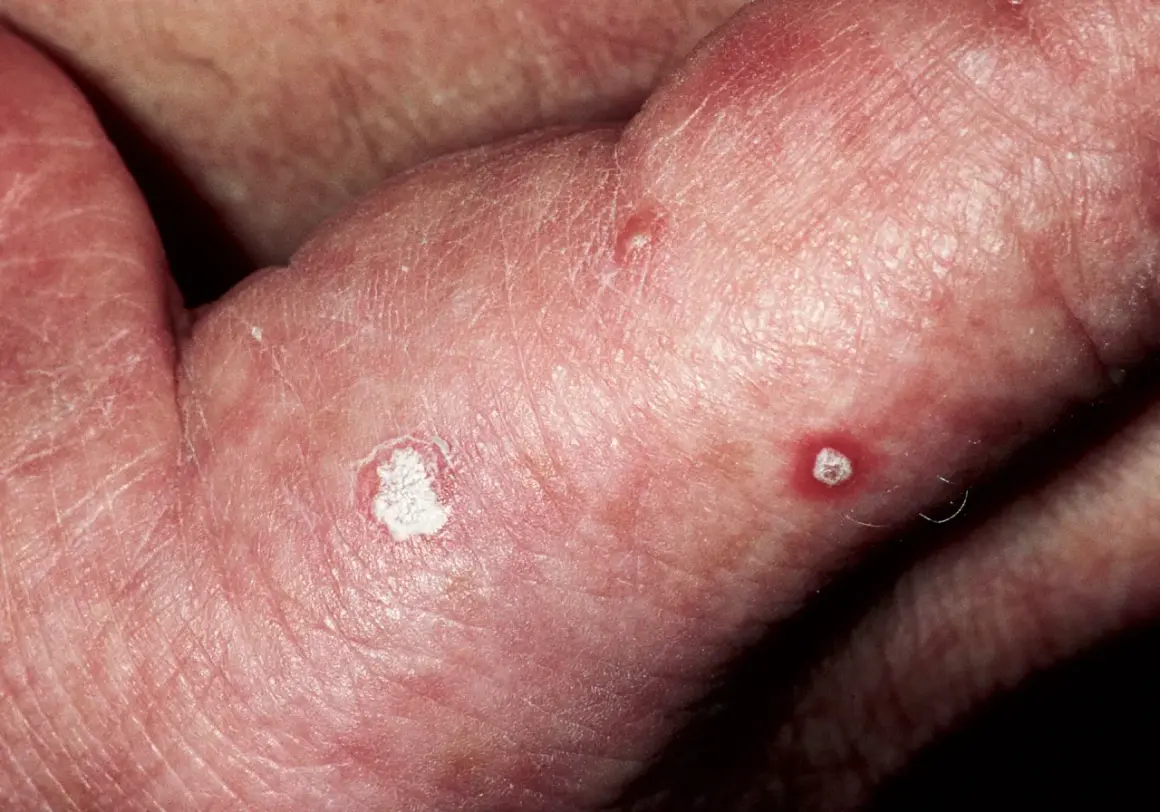 Piel enrojecida con escamas blancas y pequeñas lesiones, indicativas de queratosis actínica.