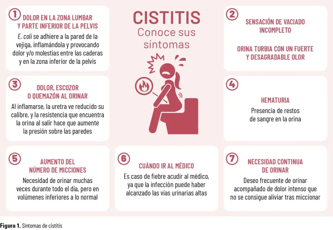 La cistitis, aunque no es contagiosa, causa dolor lumbar, ardor al orinar, orina turbia y necesidad constante de miccionar.