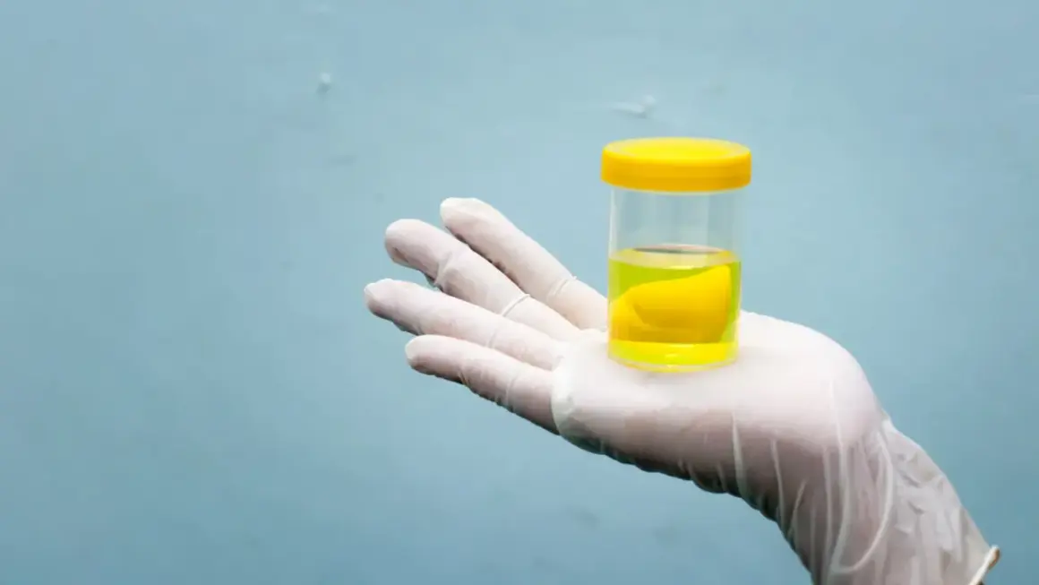 Muestra de orina oscura color coñac. Las causas pueden ser deshidratación, medicamentos o problemas hepáticos.