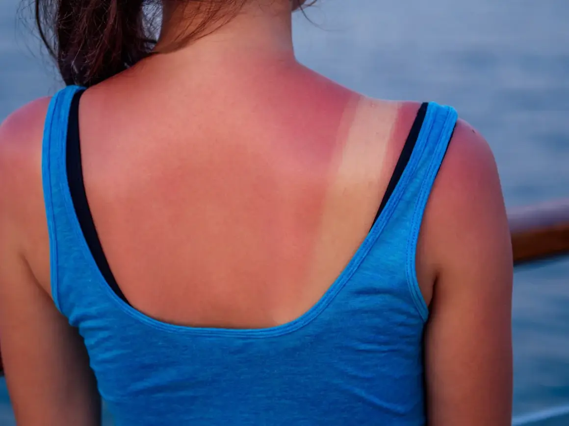 Espalda enrojecida por el sol, con una marca de bronceado. La pregunta de cuanto tiempo tomar el sol para ponerse moreno es clave para evitar esto.