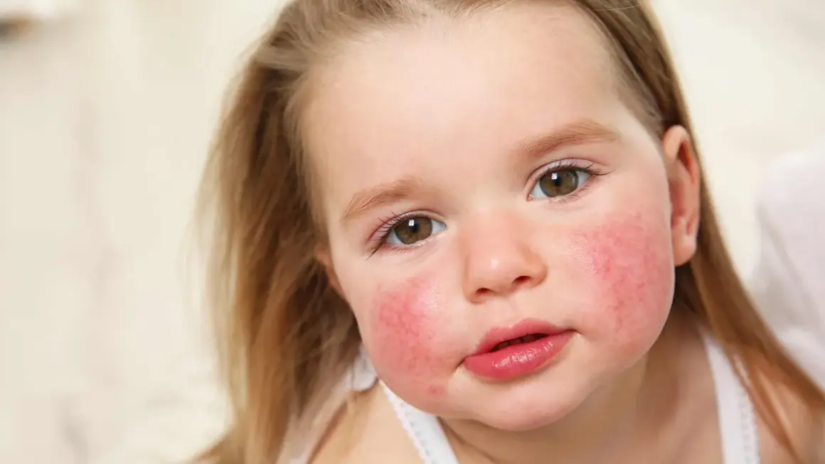 Primer plano de una niña con mejillas rojas y escamosas, indicativo de piel atópica.
