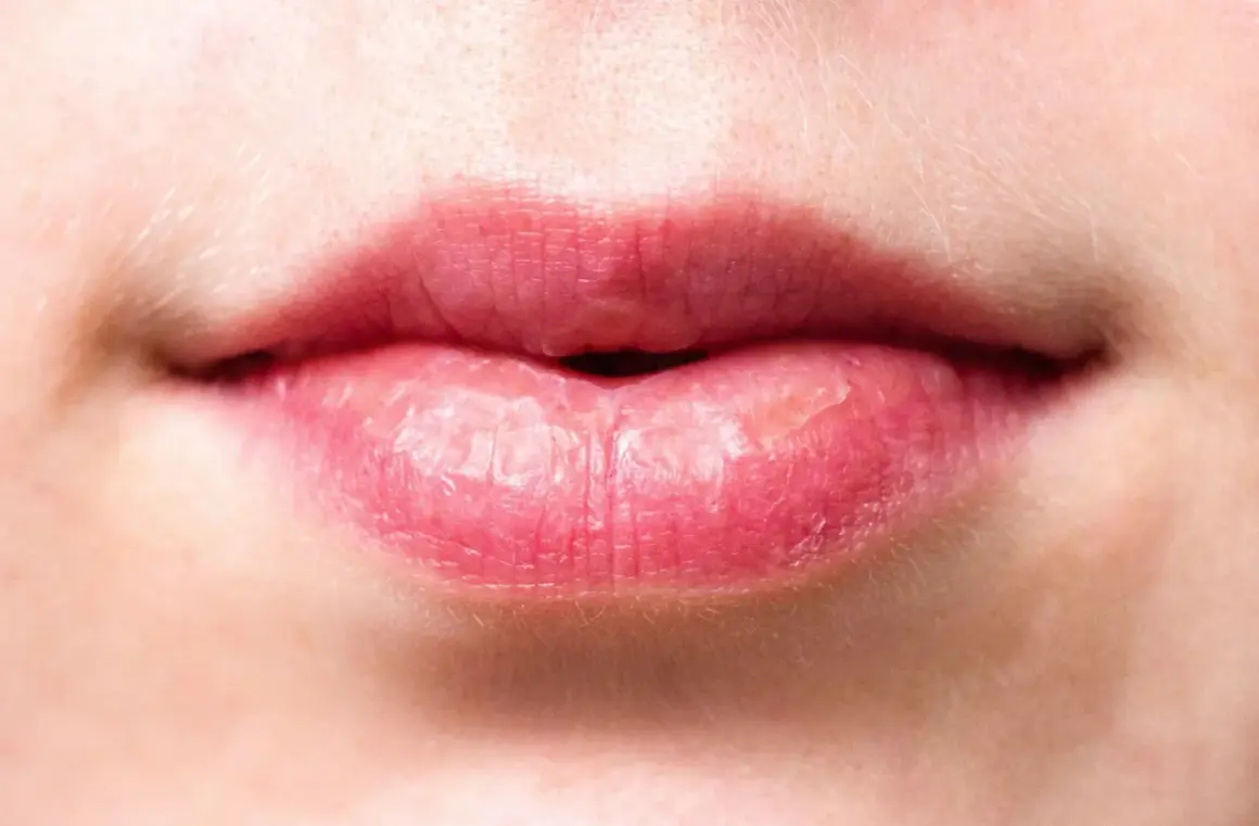 Labios agrietados y secos, con aspecto de labios quemados por el sol, mostrando la necesidad de protección e hidratación.