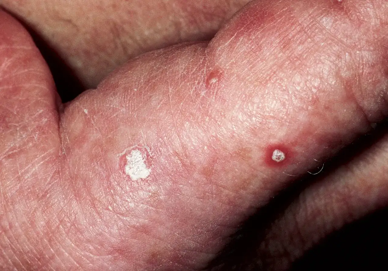 Queratosis actínica - cómo reconocerla y cuándo consultar