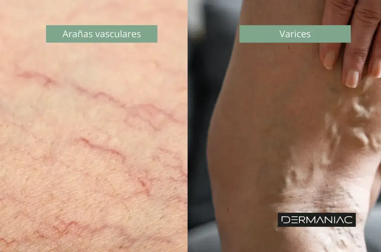Arañas vasculares - causas, cuidados y tratamientos