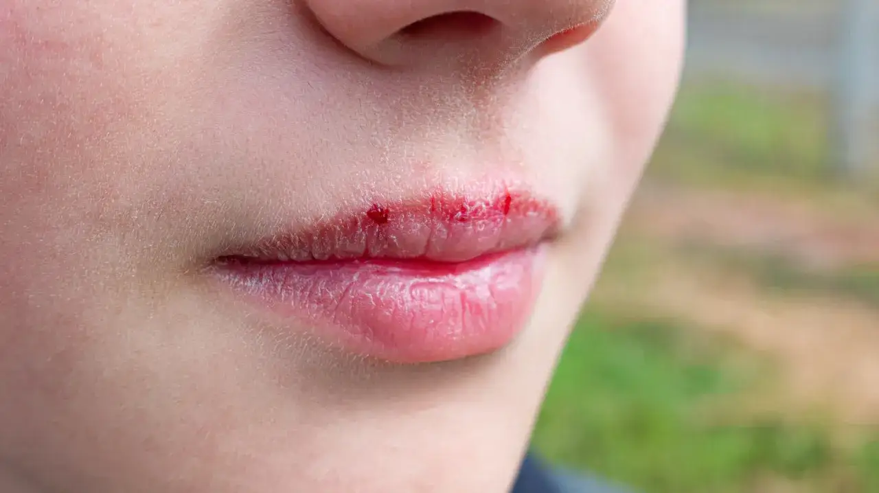 Labios agrietados y con peque&ntilde;as heridas, como si hubieran sufrido quemaduras por el sol.